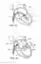 Fig. 08 - Percutaneous heart valve prosthesis