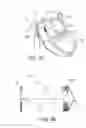 Fig. 09 - Percutaneous heart valve prosthesis