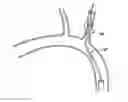 Fig. 01 - Methods and apparatus for treating neurovascular venous outflow obstruction