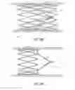 Fig. 08 - Methods and apparatus for treating neurovascular venous outflow obstruction