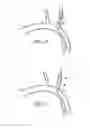 Fig. 22 - Methods and apparatus for treating neurovascular venous outflow obstruction