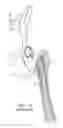 Fig. 02 - Femoral stem and post system for hip prosthesis
