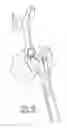 Fig. 03 - Femoral stem and post system for hip prosthesis