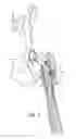 Fig. 09 - Femoral stem and post system for hip prosthesis