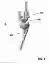 Fig. 04 - Total wrist prosthesis and related methods