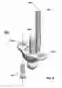Fig. 09 - Total wrist prosthesis and related methods