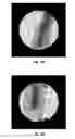 Fig. 04 - Magnetic prosthetic implants and methods thereof