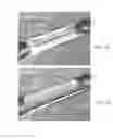 Fig. 23 - Endovascular implant