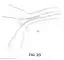 Fig. 04 - DEVICES AND METHODS FOR OCCLUDING A FALLOPIAN TUBE