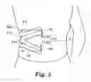 Fig. 06 - SKIN ADHESIVE MEMBER
