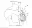 Fig. 01 - STRESS RELIEVING DEVICE