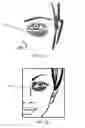 Fig. 05 - METHOD OF IMPROVING THE APPEARANCE OF PERIORBITAL DYSCHROMIA