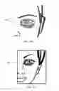 Fig. 05 - METHOD OF IMPROVING THE APPEARANCE OF PERIORBITAL DYSCHROMIA