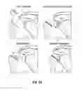Fig. 08 - Joint replacement or joint resurfacing devices, systems and methods