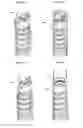 Fig. 03 - Method for assembling a drive spring and drug delivery device with a spring