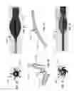 Fig. 08 - Weeping balloon devices