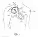 Fig. 02 - Interconnection of conductor to feedthrough