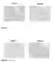 Fig. 11 - Analysis of T-cell monotypia