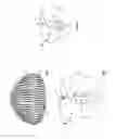 Fig. 02 - METHODS AND SYSTEMS FOR TREATING MEIBOMIAN GLAND DYSFUNCTION USING RADIO-FREQUENCY ENERGY