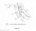Fig. 13 - METHODS AND SYSTEMS FOR TREATING MEIBOMIAN GLAND DYSFUNCTION USING RADIO-FREQUENCY ENERGY