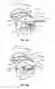 Fig. 23 - METHODS AND SYSTEMS FOR TREATING MEIBOMIAN GLAND DYSFUNCTION USING RADIO-FREQUENCY ENERGY