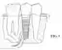 Fig. 02 - Fluted osteotome and surgical method for use