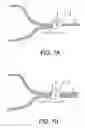 Fig. 06 - Implants and methods for treatments of pelvic conditions