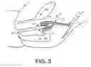 Fig. 08 - Implants and methods for treatments of pelvic conditions