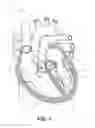 Fig. 02 - Beating-heart mitral valve chordae replacement