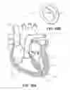 Fig. 09 - Beating-heart mitral valve chordae replacement