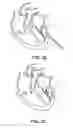 Fig. 22 - Beating-heart mitral valve chordae replacement
