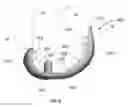 Fig. 07 - Flexible snap-fit prosthetic component