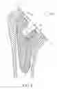 Fig. 06 - Shoulder arthroplasty implant system
