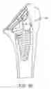 Fig. 32 - Shoulder arthroplasty implant system