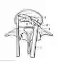 Fig. 01 - Posterior intervertebral disc inserter and expansion techniques