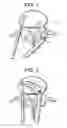 Fig. 02 - Posterior intervertebral disc inserter and expansion techniques