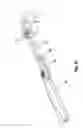 Fig. 35 - METHOD FOR INSERTING AND POSITIONING AN ARTIFICIAL DISC