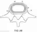 Fig. 04 - In-situ formed intervertebral fusion device and method