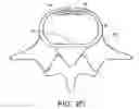 Fig. 06 - In-situ formed intervertebral fusion device and method