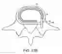 Fig. 22 - In-situ formed intervertebral fusion device and method