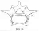 Fig. 28 - In-situ formed intervertebral fusion device and method