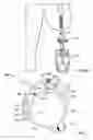 Fig. 03 - Safety overload for direct skeletal attachment