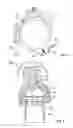 Fig. 04 - Safety overload for direct skeletal attachment