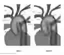Fig. 09 - Apparatus and method for improved access of procedural catheter in tortuous vessels