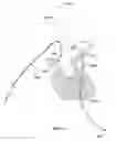 Fig. 32 - Apparatus and method for improved access of procedural catheter in tortuous vessels