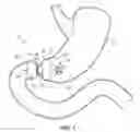 Fig. 02 - Implantable weight control device to promote early and prolonged satiety in a bariatric patient