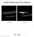 Fig. 26 - METHODS OF TREATING HYPOXIA-ASSOCIATED OPTICAL CONDITIONS WITH CARTILAGE OLIGO MATRIX PROTEIN-ANGIOPOIETIN 1 (COMP-ANG1)