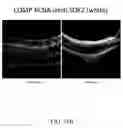 Fig. 30 - METHODS OF TREATING HYPOXIA-ASSOCIATED OPTICAL CONDITIONS WITH CARTILAGE OLIGO MATRIX PROTEIN-ANGIOPOIETIN 1 (COMP-ANG1)