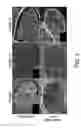 Fig. 04 - Injectable peripheral nerve specific hydrogel