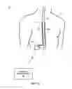 Fig. 02 - Therapy system including multiple posture sensors